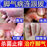 脚气药膏止痒脱皮烂脚丫真菌感染专用药正品治脚气脚臭的药香港脚皮肤用药硝酸咪康唑乳膏去跟看脚缝根痒得治 3盒装【不拖鞋能闻到味】
