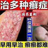 牛皮鲜癣专用药顽固牛皮癣真菌王银屑病牛皮癣i药膏中药治疗断药根药去根止痒抑菌抗真菌感染皮肤用药华佗膏 1盒【华佗膏】杀菌止痒顽癣敌100%发货特效快
