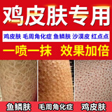 示博士鸡皮肤疙瘩搭毛囊角化症专用的药去角质大腿手臂去除神器特傚膏用 一套【喷剂+乳膏】轻度鸡皮 搭身体乳去鸡皮毛囊角质疙瘩品用