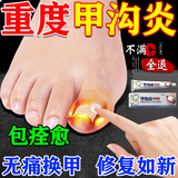 株式会社甲沟炎外用药膏消肿止痛专用矫正器去根消肿去肉芽药水息肉抑菌液 特效1盒【专攻甲沟炎】 专用严重指甲嵌甲不长肉里进口