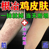 山本星奈进口鸡皮肤疙瘩毛周角化症专用干燥毛囊角质疙瘩大腿神器专用膏药 九盒装【鸡皮修复】店长推荐 鸡皮毛囊膏去除神器100%