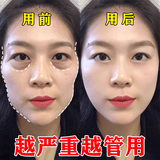 脸部凹陷填充液胶原蛋白太阳穴泪沟眼窝凹陷填充神器面部修复精华 买2送1【三天变圆脸】