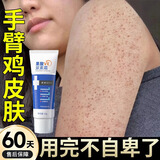 倾龄果酸VE尿素霜改善鸡皮肤胳膊上的小圪塔毛周角化维生素e身体乳膏 1支50g【鸡皮肤去除神器】
