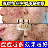 AOPY祛痘膏青春痘粉刺产品霜凝胶贴青少年学生痤疮痘痘痘坑精华液淡化 一瓶装