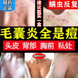 川石克霉唑乳膏喷雾毛囊炎药膏后背除螨虫的药疙瘩止痒杀菌抗真菌感染皮肤用药头部脓疱疮祛痘消炎痤疮青少年专用 1盒正品医用级痘痘马拉色菌后背部前胸癣祛图视觉特效