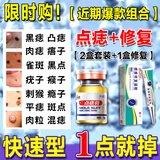 点痣膏水疤痕修复脸部去痣点痣膏官方正品祛斑点斑专用非药点疣水 限购组合装：黑痣首选款【到手3盒】