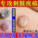 猴子去除药膏去猴子专用特强效药刺猴专用的皮肤用药寻常疣去除膏瘊子去除特新疗效药刺猴疣体根水杨酸软膏 一盒【肉粒刺猴去除专用药膏】主图%100视觉效特