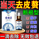 疣瘊克皮赘肉粒去除神器脖子上长的小疙瘩肉瘤祛疣体瘊猴子专用脱落药膏 特效3盒【去扁平疣丝状疣点痣】