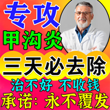株式会社甲沟炎外用药膏消肿止痛专用矫正器去根消肿去肉芽药水息肉抑菌液 特效丨盒【专攻甲沟炎】 专用严重指甲嵌甲不长肉里进口