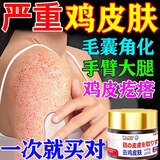 岩井昃弘鸡皮肤去除神器毛周角化症专用去鸡皮肤毛囊角质疙瘩大腿干燥药膏 买二赠一【疗程装】中度鸡皮肤