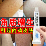 鸡皮肤疙瘩毛囊角化症专用药 鸡皮肤去除器神毛周角化 鸡皮疙瘩专用药膏水杨酸软膏 1支【严重鸡皮肤】快速修复