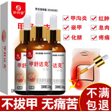 妙丹堂甲沟炎专用消肿去肉芽指甲长肉里根手脚嵌甲息肉除矫正器治非药膏 三盒装