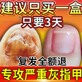 亮甲灰指甲特傚效药灰甲净根i治正品真菌感染增亮灰指甲日本进抑菌口 买二送一【轻度灰甲】京东 京东治疗灰指甲的最新亮甲灰指甲专用大药房