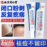 惜药师闭口粉刺克星祛痘消炎毛孔堵塞逆光疹药膏脸上起小疙瘩祛额头痘痘 家庭闭口粉刺膏【一盒装】