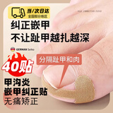 格蒙甲沟矫正器贴片炎嵌甲神器防脚指甲往肉里长专用隔离工具填充垫片