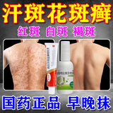 [拜都帮]曲安奈德益康唑乳膏 汗斑花斑癣专用药汗斑专用药(发货特效)真菌感染皮肤用药皮肤白斑汗斑净 曲安奈德益康唑乳膏1支+盐酸特比萘芬喷雾剂1瓶
