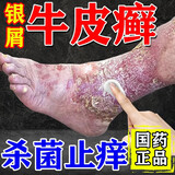 华佗膏牛皮癣银屑病专用药顽固牛皮癣银屑病去真菌止痒抑菌皮肤药膏皮肤瘙痒身体痒华佗膏皮肤用药【视觉特效】 3盒装【严重牛皮癣 全身白屑】