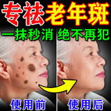 肤研祛斑霜去老年斑专用特效非药一夜消黄褐斑雀斑晒斑女男士医用的药 特效膏|盒【肤研美百祛斑霜强效第1名】 强力祛除手部脸部淡化黑色素纯中药正品进口