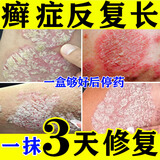 [扬子洲]硝酸咪康唑乳膏 2%*20g 1盒装 体股癣牛皮肤癣专用特正效药银屑病药膏止痒抑菌皮肤皮炎湿疹皮癣真菌感染止痒膏 治各种癣巨牛 止痒抑菌