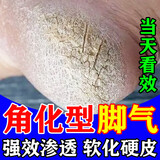 角化型脚气顽固性真菌感染角质增厚脚后跟干裂专用药脚脱皮去真菌皮肤干裂脱皮厚硬手足鳞屑型硝酸咪康唑乳膏 1盒【足跟粗糙开裂脱皮】主图视觉特效