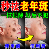 碧素堂祛斑霜老年斑专用特效非药一夜消强力祛除手部脸部男女祛斑专用霜 一盒装 祛斑效果最好的产品