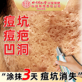 乔记去痘痘和痘印修复凹洞男淡化痘坑消填充再生凝胶生长收缩毛孔医用 膏体*5【想抹平痘坑痘印】多数人选择 祛痘印痘坑修复男生痘印痘坑痘疤修复淡化消除黑色素
