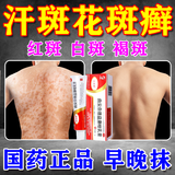 [拜都帮]曲安奈德益康唑乳膏 汗斑花斑癣专用药汗斑专用药(发货特效)真菌感染皮肤用药皮肤白斑汗斑净 15g 1支装 【真菌感染】