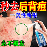 同仁堂后背痘痘药膏后背长痘痘毛囊炎专用前胸后背部脓包除螨祛痘喷雾剂 一盒装【多买多送】发货特效快