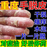 [嘉效]醋酸曲安奈德益康唑乳膏 手起皮脱皮干裂真菌感染特新效药专用药膏鹅掌风手足干裂手癣皮肤起水泡痒 20g 1盒装 【手脱皮专用药膏】