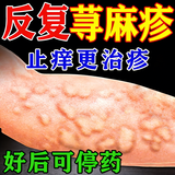 [吉华舒]荨麻疹丸 荨麻疹专用药 皮肤过敏瘙痒止痒断药根增强发货免疫力过敏药中药调理止痒【视觉特效】 10g*9袋 5盒装 【反复发作患者选择】