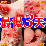 [嘉效]醋酸曲安奈德益康唑乳膏 去脚气药止痒脱皮烂脚丫真菌感染药膏根痒治脚臭脚气专用药(发货特效) 20g 3盒装 【中度脚气瘙痒脱皮【视觉特效】
