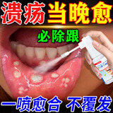 北京协和医学院口腔溃疡喷雾剂口舌生疮嘴巴上火起泡神器烂嘴药口腔黏膜修复专用 1盒装【专冶口腔溃疡】 口腔溃疡专用特效的