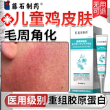 藤石制药儿童鸡皮肤毛周角化去除神器药脸部软化毛囊角化症脸上有小颗粒O6 正品保障  修复皮肤屏障专用  无用可退