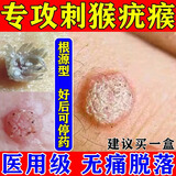 猴子去除药膏去猴子专用特强效药刺猴专用的皮肤用药寻常疣去除膏瘊子去除特新疗效药刺猴疣体根水杨酸软膏 一盒【肉粒刺猴去除专用药膏】主图%100视觉效特