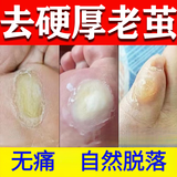 胖东来代购去老茧去脚底老茧去硬皮老茧软化膏茧子去除脚钉专佣用药去茧 1盒云南本草鸡茧膏软化角质去硬皮