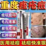 [花容美]阿达帕林凝胶 祛痘药膏祛痘印修复淡化痘印医用祛痘消炎痤疮专用青少年祛痘消炎痤疮专用皮肤用药 0.1%*10g 2盒装 【熬夜老起痘】