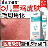 藤石制药儿童鸡皮肤毛周角化去除神器药脸部软化毛囊角化症脸上有小颗粒O6 正品保障  修复皮肤屏障专用  无用可退