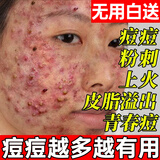 同仁堂祛痘药膏淡化痘印去痘痘和痘印痘坑男女青少年学生青春痘专用20g