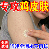 鸡皮肤疙瘩毛囊角化专用去除大腿胳膊手臂药膏身体乳霜毛周角化症 单盒装【鸡皮肤克星】 角质化增生专用的药磨砂膏去除神器