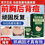 祥醫堂马拉色菌专用毛囊喷雾头皮部毛囊炎痒有红疙瘩前胸后背除螨痘