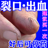 [扬子洲]硝酸咪康唑乳膏 2%*20g 1盒装 手癣真菌感染药手裂口干裂膏皲裂膏手足皮肤干燥开裂膏手开裂用药手指裂口愈 手癣手裂口用药
