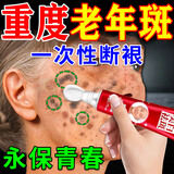 北京协和医学院祛斑霜老年斑专用特效非药一夜消去老年斑的药强力祛除手部脸部 特效1盒【祛斑点斑专用的药水医用级正品】 美i白祛斑霜淡化黑色素去黄褐斑雀斑晒斑男女士专用的