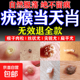 去i疣体扁平疣丝状疣专用瘊子猴子脱落膏hpv祛疣神器 一盒