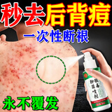 后背痘痘毛囊炎专用喷雾药后背长痘痘前胸后背部脓包除螨祛痘喷剂 买2送1【实发3盒】发货特效快