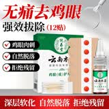 纯春堂云南本草鸡眼贴膏手部足部去除疣跖脚后跟脚垫老茧刺猴子鸡眼膏