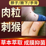 森卓止尤净跖疣专用非药脚底趾疣根鸦胆子脚上疣体hpv祛疣非药膏去除 【肉粒猴子】1盒装蓝色去尤乐