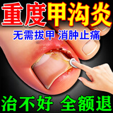 珩琦甲沟炎专用消肿药膏去肉芽根冶治矫正神器大脚趾指甲往肉里长的药 1盒【 特效脱甲草本抑菌膏】基础装 去根消肿止痛去肉芽治严重息肉指甲长在肉里嵌甲抑菌液