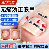 力仕康甲沟炎专用矫正神器甲沟炎专用指甲刀纠正嵌甲指甲长肉里矫正贴
