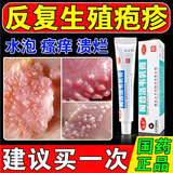 [太平]阿昔洛韦乳膏 10g:0.3g*10g 2支装 软i膏生殖疱疹特新效药疱疹药膏男女下体私处生殖器疱疹特新效药瘙痒水泡流脓病毒感 生殖疱疹疼痒