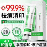 初蔓祛痘膏淡化痘印壬二酸15%凝胶祛痘印水杨酸积雪草祛痘青少年专用 【皮肤科推荐】积雪草祛痘修护膏30g*1 院线专研&大药房在售